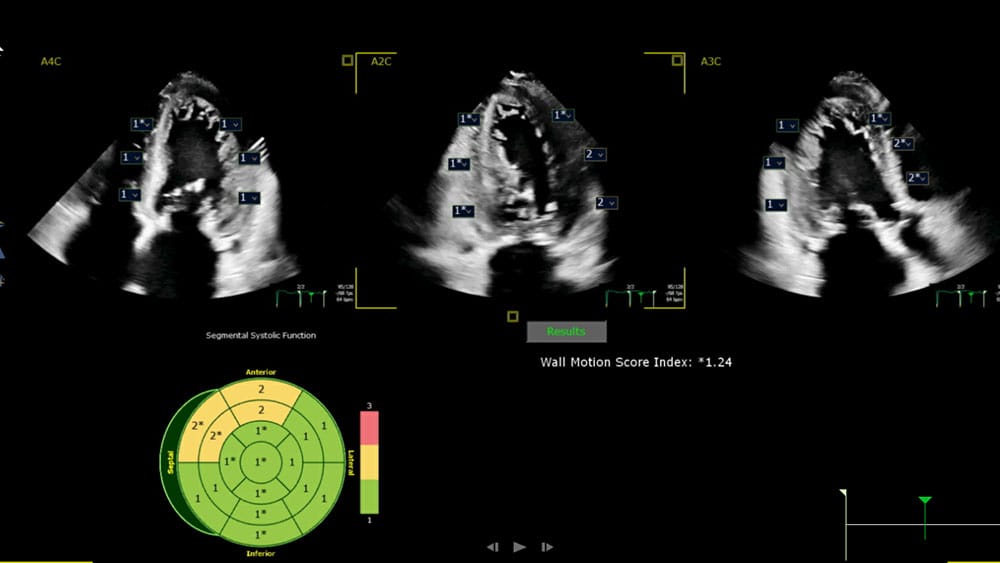 EPIQ CVx and Affiniti CVx with Segmental Wall Motion