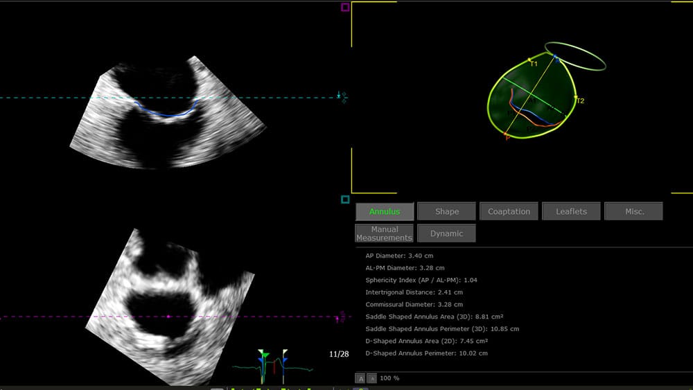 EPIQ CVx and CVxi with 3D Auto MV