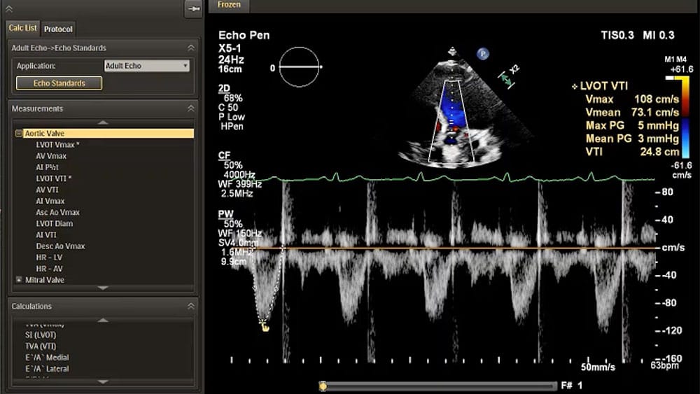 EPIQ CVx and CVxi with Smart Doppler View ID