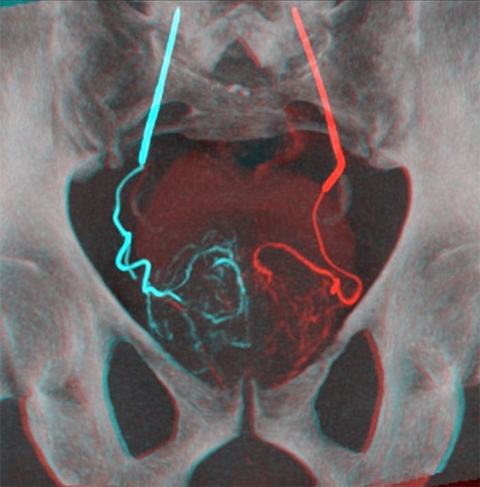 Overlay of 2 CBCT images for the embolization of the left prostatic artery and of the right prostatic artery (Image courtesy of Dr. Tiago Bilhim)