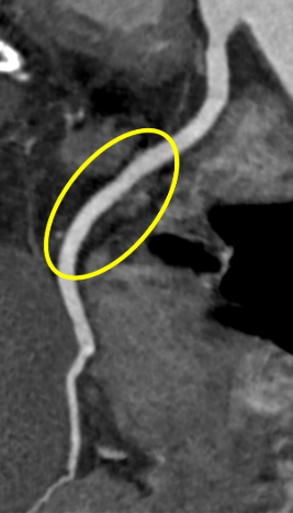 precise cardiac resized